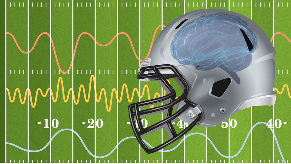 EEG analysis may detect up to 99.5% of concussions